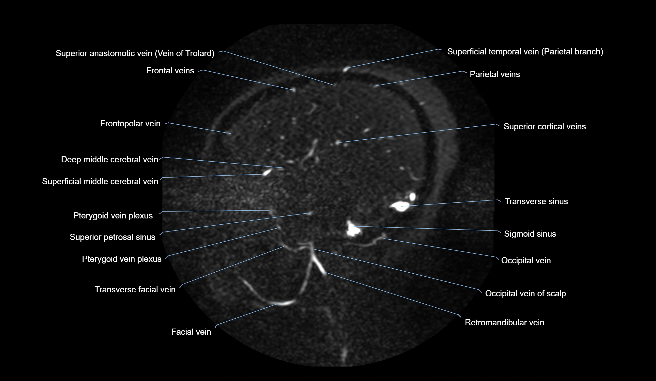 MRV brain sagittal anatomy 3T MRI labelledimages -00021.webp